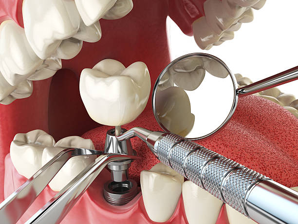 Best Emergency Tooth Extraction in Trempealeau, WI
